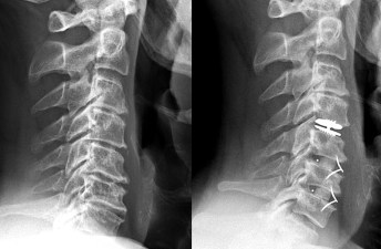 carbonelle-pre-post-hybrid