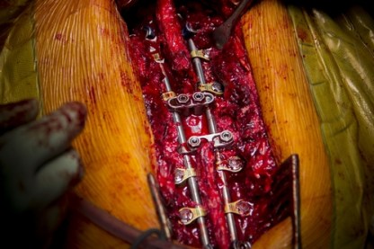 laminectomie-arthrodese-1-small