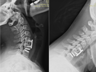 prosthesis-versus-cervfusion-dynamiques